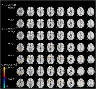 Altered functional connectivity of the primary motor cortex in tremor dominant and postural instability gait difficulty subtypes of early drug-naive Parkinson’s disease patients